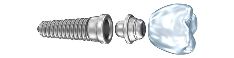 Implant zębowy