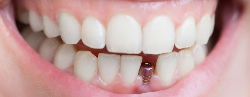 Uśmiech z implantem zębowym